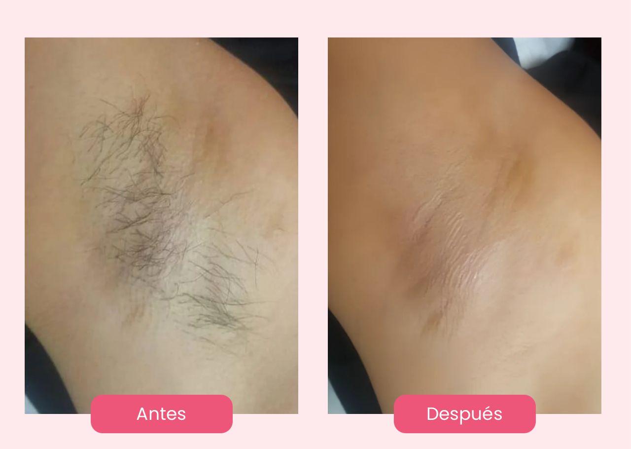 ShinnySkin® Depiladora Láser Permanente IPL